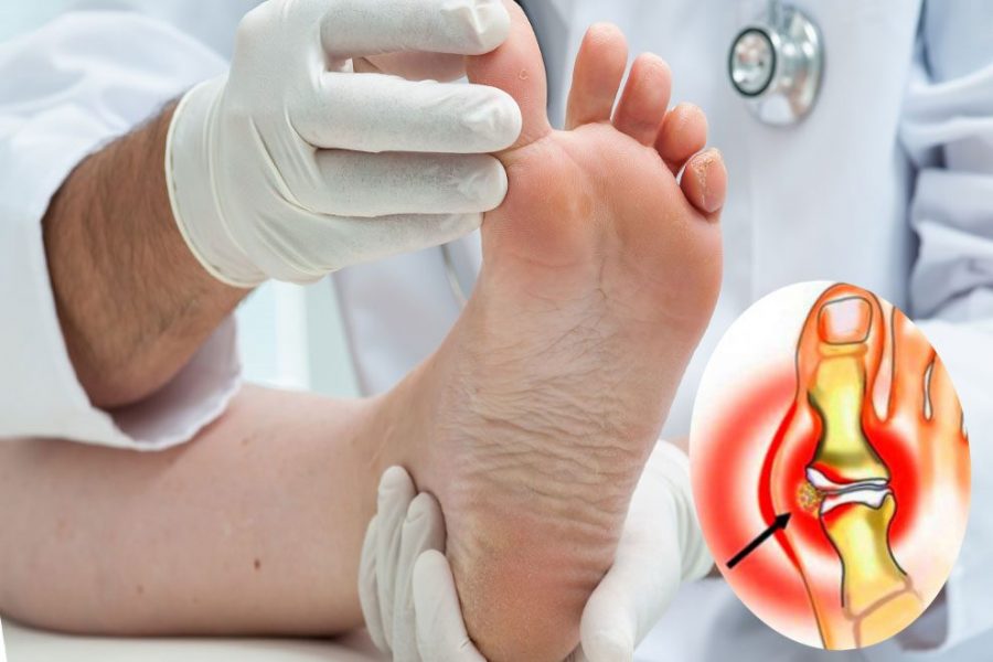 Как снять воспаление суставов пальцев ног